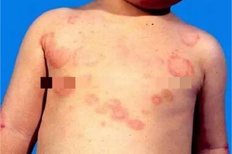 风湿性边缘性红斑症状图