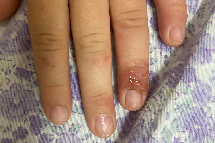女性手指疱疹性瘭疽图