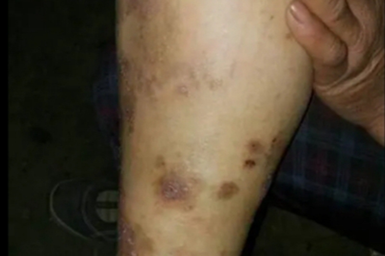 瘙痒症小腿黑斑图 瘙痒症小腿黑斑图