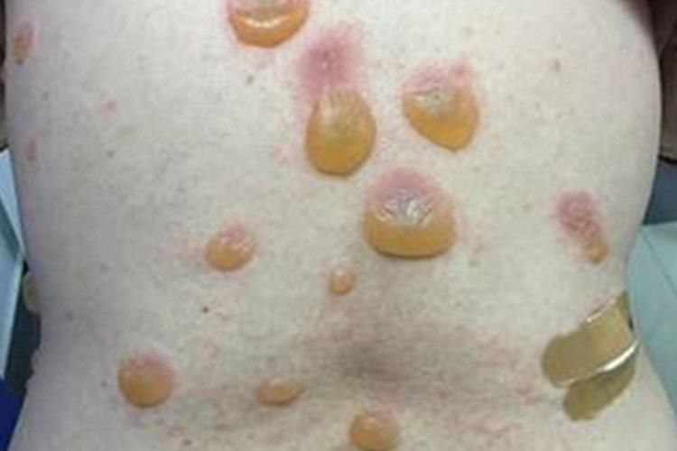 背部天疱疮早期皮损图