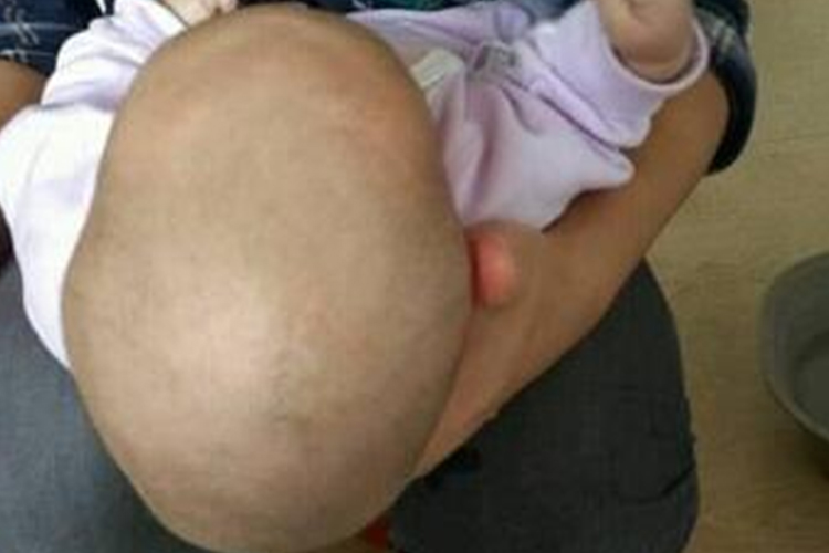 婴儿舟状头畸形图
