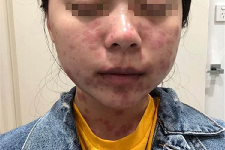 寒冷性多形红斑面部斑图