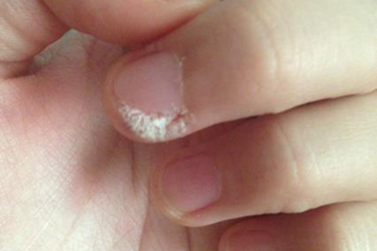 寻常疣手指甲增厚图