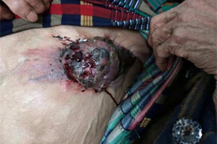 乳腺癌乳房结节图