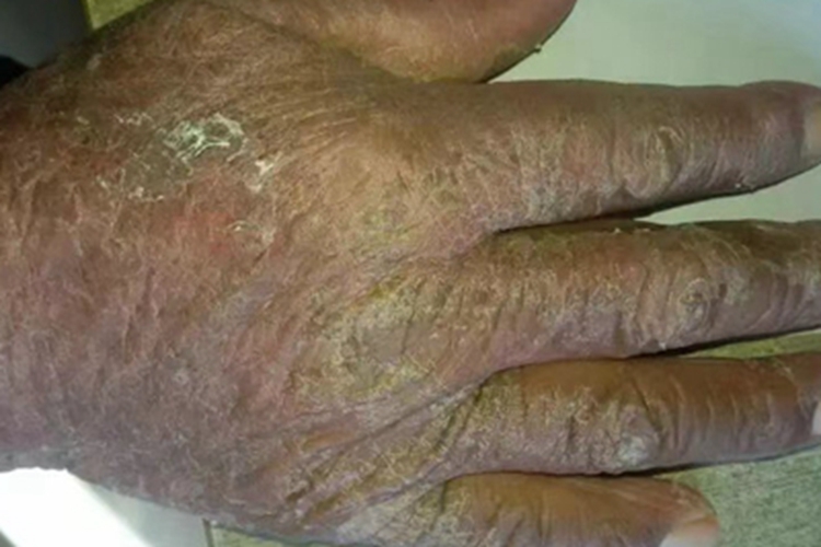 慢性湿疹手背皮肤增厚图 慢性湿疹手背皮肤增厚图