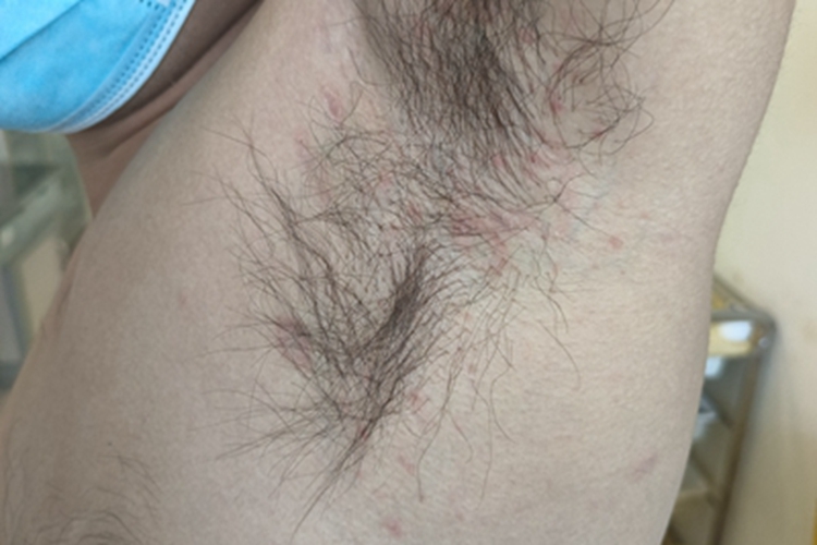 玫瑰糠疹腋窝症状图