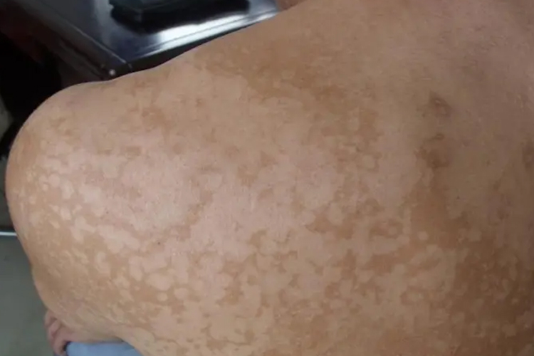 花斑癣后背白斑图