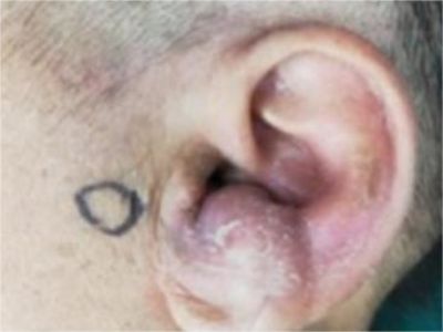 耳廓化脓性软骨膜炎耳廓肿了一个大包图.jpeg