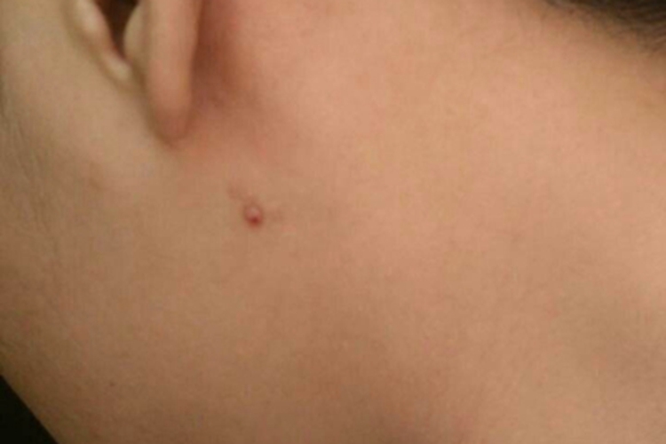 皮内痣耳周小疙瘩图