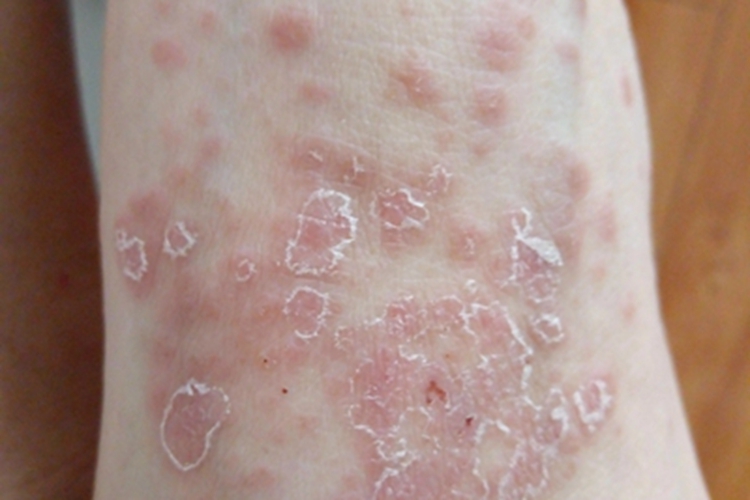 三期梅毒脚踝脱皮图