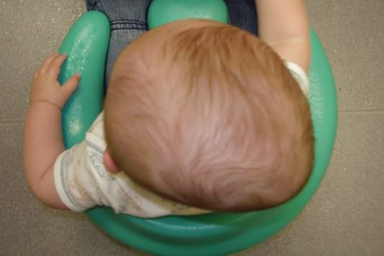 婴儿斜头畸形图