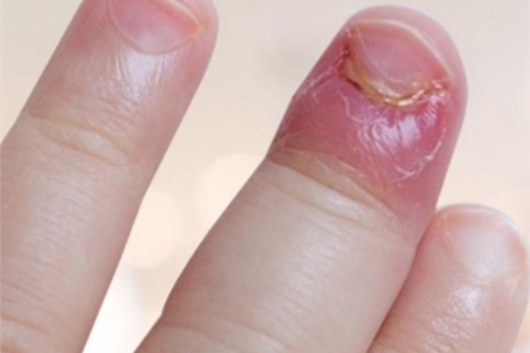 脓性指头炎手指化脓图 脓性指头炎手指化脓图