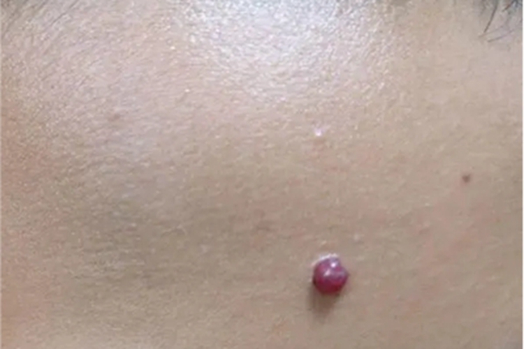 肉芽肿型血管瘤前额症状图