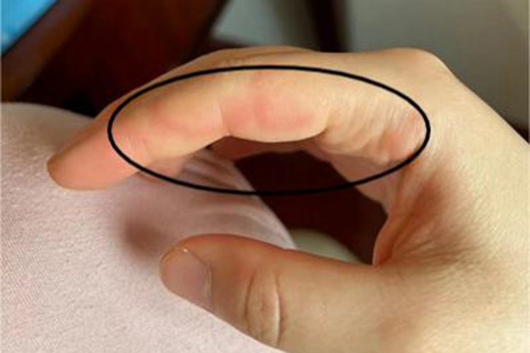 荨麻疹手指症状图 荨麻疹手指症状图