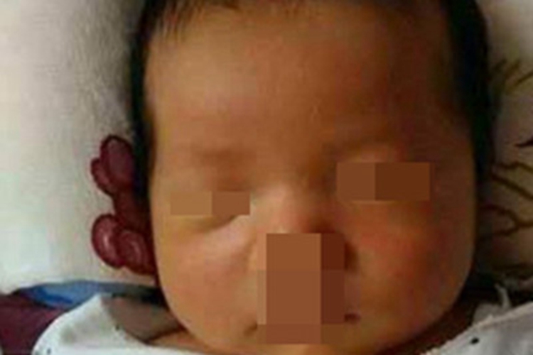 新生儿病理性黄疸面部皮肤发黄图