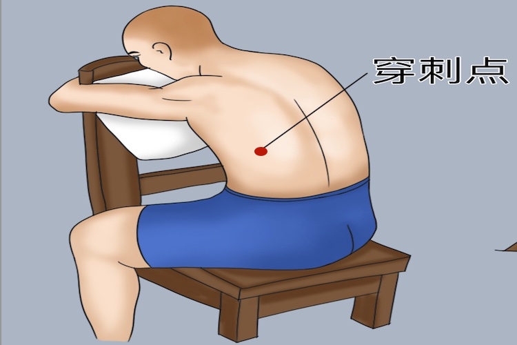 腹腔闭式引流穿刺位置图