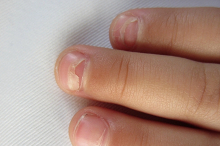 脱甲病手指甲盖不完整图