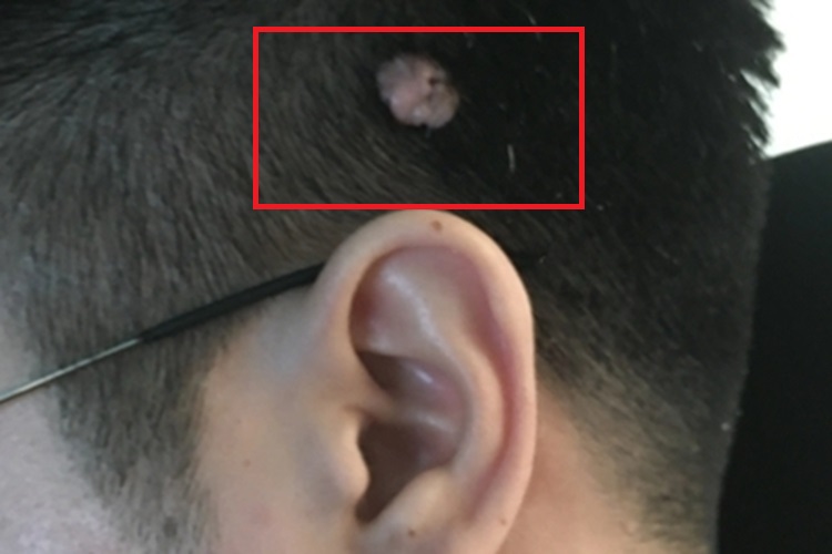 上皮样肉瘤头皮疙瘩图