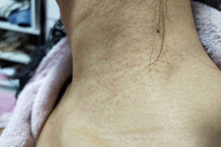 脖子毛周角化病图