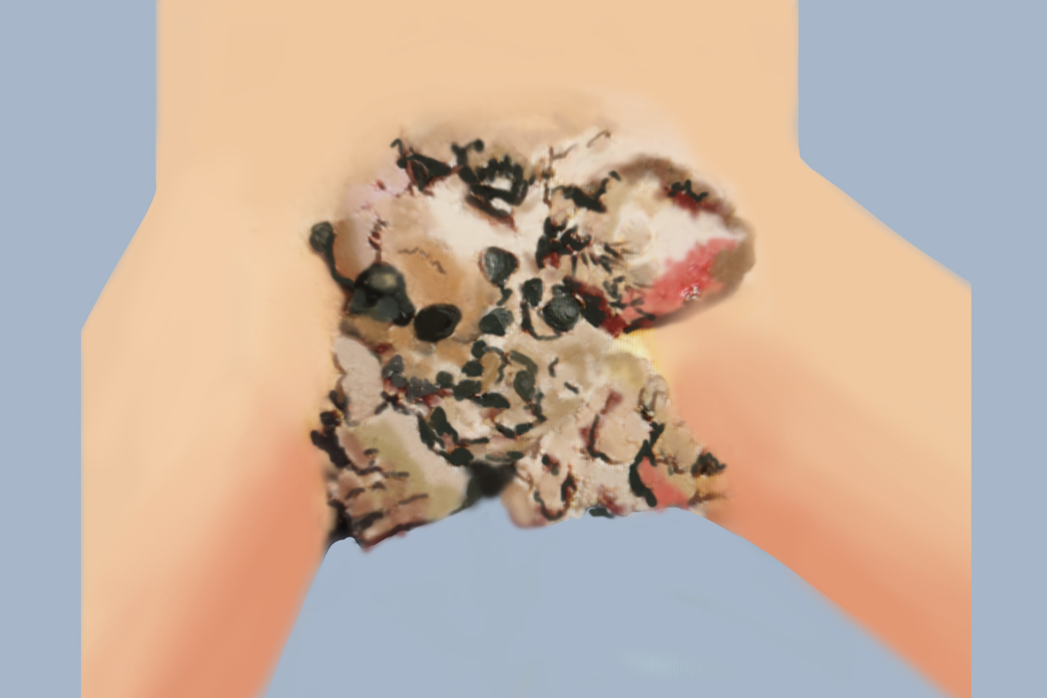 巨大尖锐湿疣图