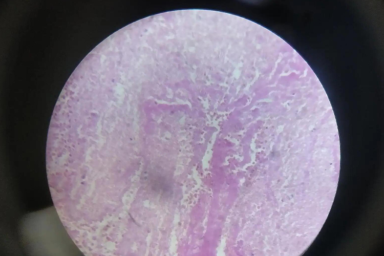 镜下血管内混合血栓图 镜下血管内混合血栓图