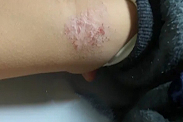 儿童期特应性皮炎胳膊丘疹图 儿童期特应性皮炎胳膊丘疹图