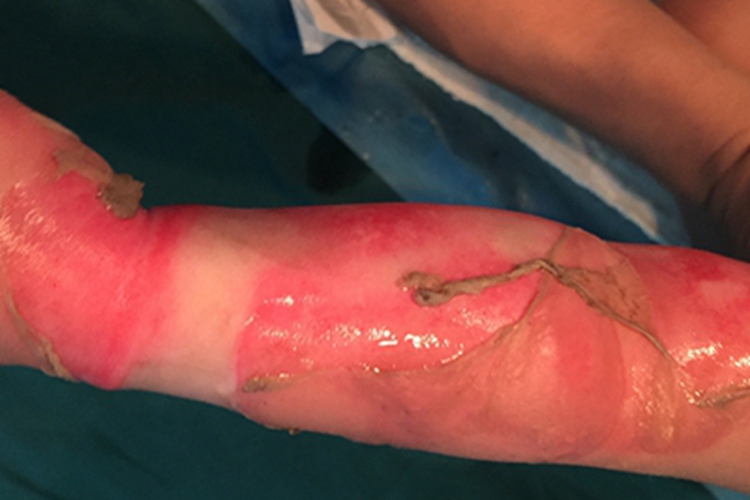 深Ⅱ度烧伤胳膊脱皮图 深Ⅱ度烧伤胳膊脱皮图