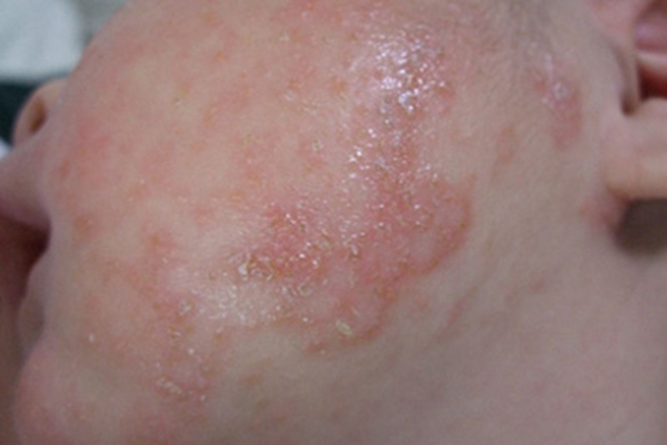 急性湿疹面部脱皮图