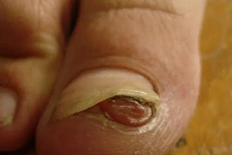 寻常疣甲床下有明显疙瘩图