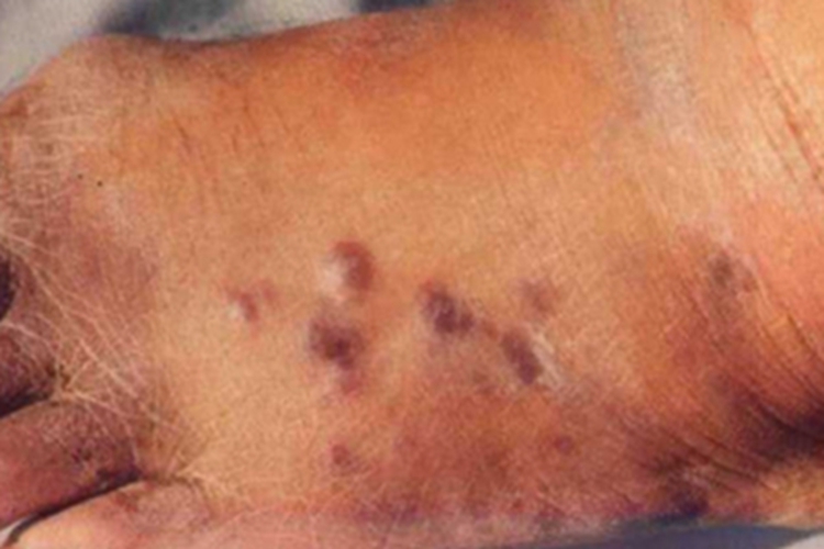 艾滋病皮肤肿瘤脚背长结节图 艾滋病皮肤肿瘤脚背长结节图