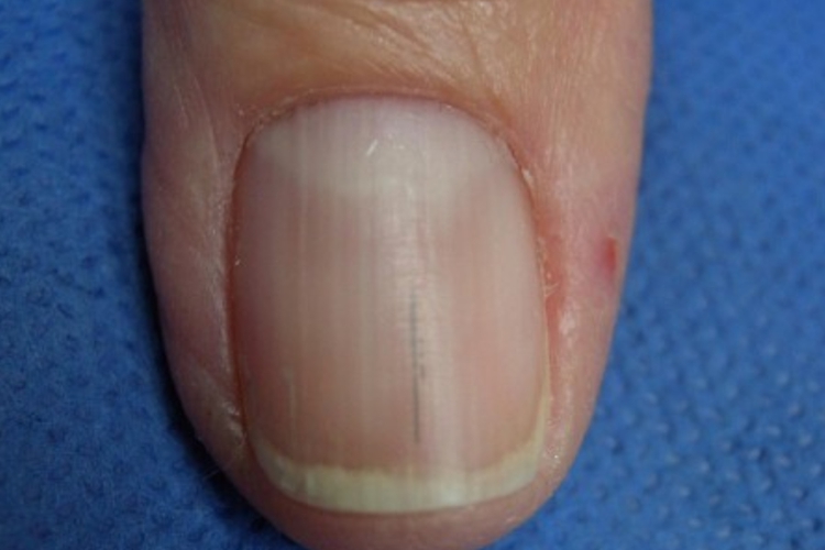 甲乳头状瘤纵行黑甲图