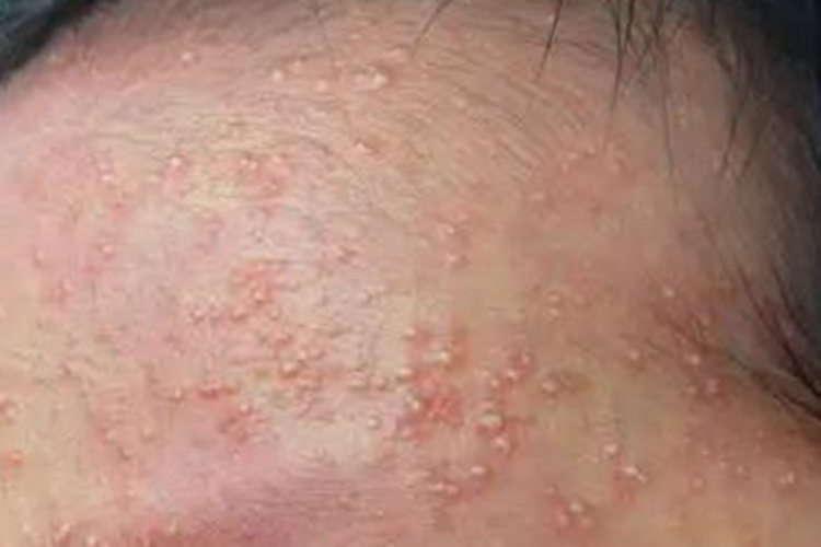 青春期前痤疮脓包图 青春期前痤疮脓包图