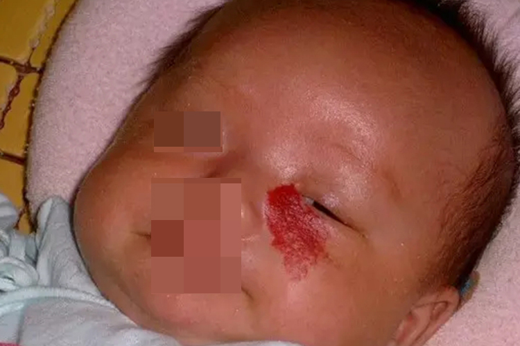 蔓状血管瘤眼角症状图 蔓状血管瘤眼角症状图