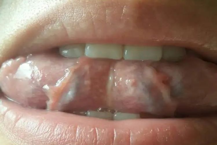 舌下肉阜图