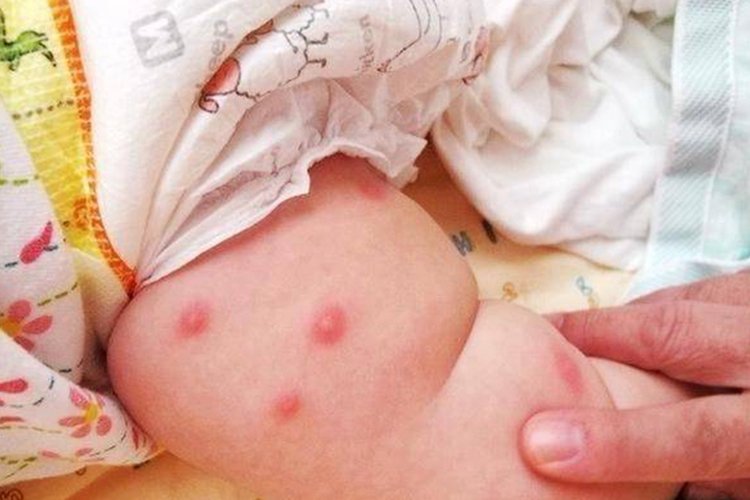 蚊虫叮咬婴儿小腿有红疙瘩图