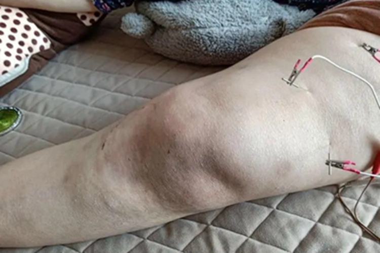 膝关节创伤性滑膜炎膝盖变形图