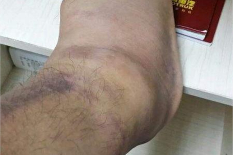 中度扭伤脚部发红肿胀图 中度扭伤脚部发红肿胀图