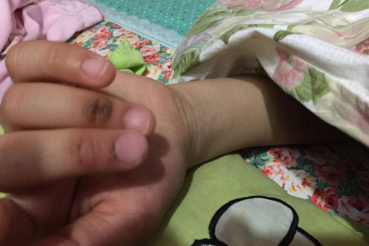 皮下血肿宝宝手指长小黑点图