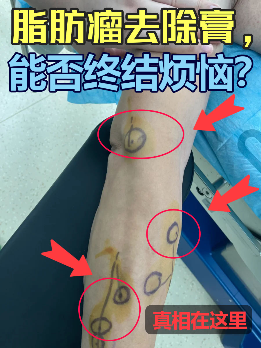 脂肪瘤去除膏，能否终结烦恼？真相在这里