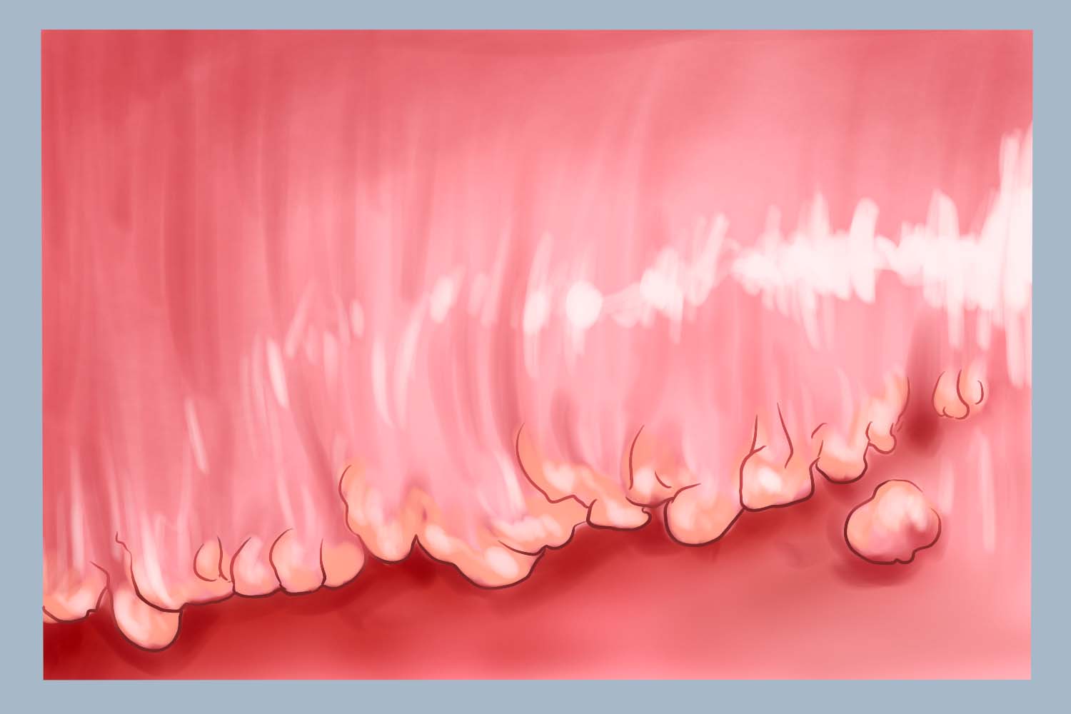 珍珠状阴茎丘疹 珍珠状阴茎丘疹