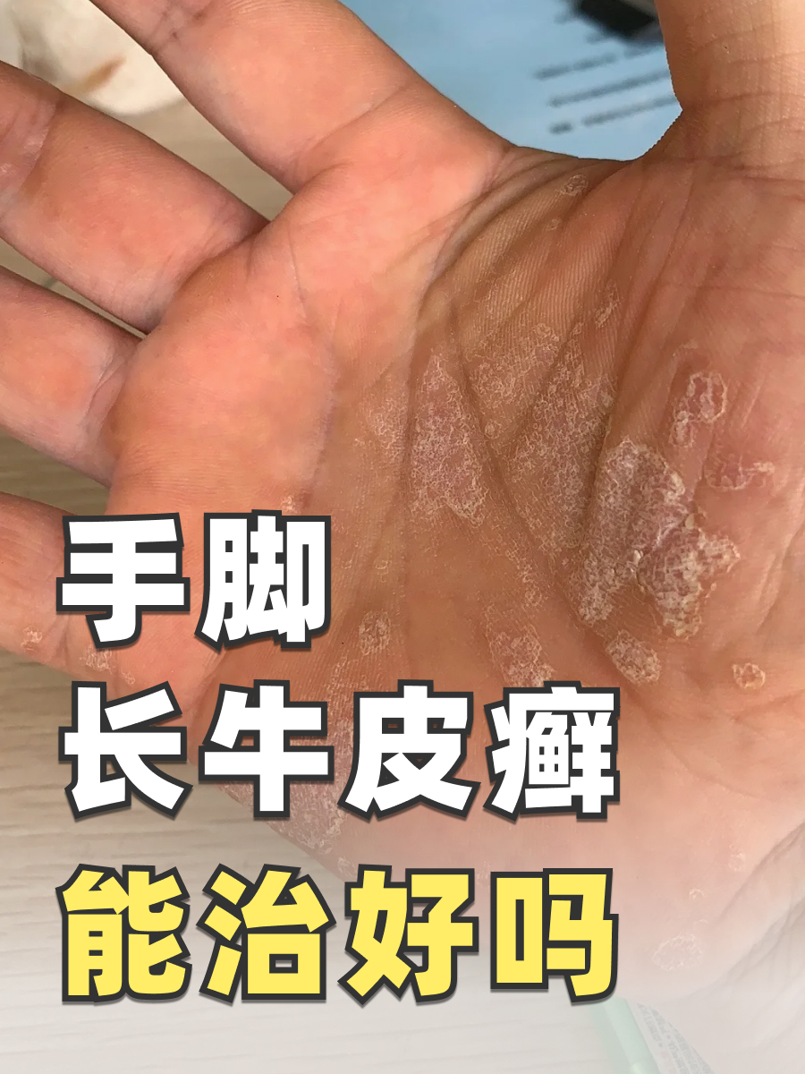 手脚长牛皮癣能治好吗？皮肤科医生来解答！