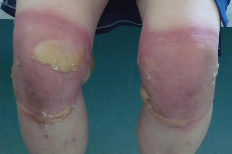 腿部急性接触性皮炎图 腿部急性接触性皮炎图
