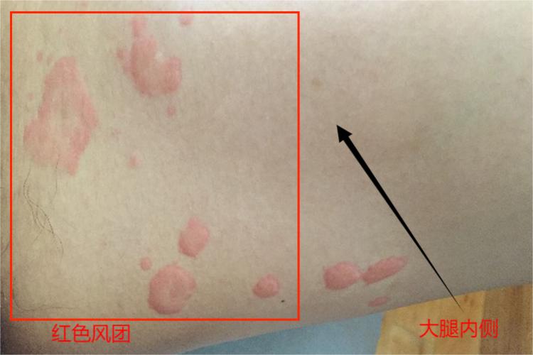 荨麻疹大腿内侧红色风团图