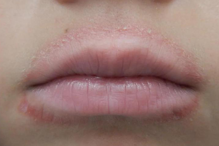 口周亚急性湿疹口周发红伴鳞屑图