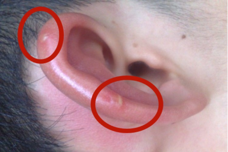 虫咬皮炎耳廓水疱图