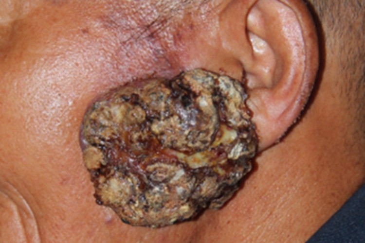 皮肤鳞状细胞癌大疙瘩图