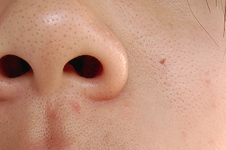 黑头鼻尖针尖样小刺图