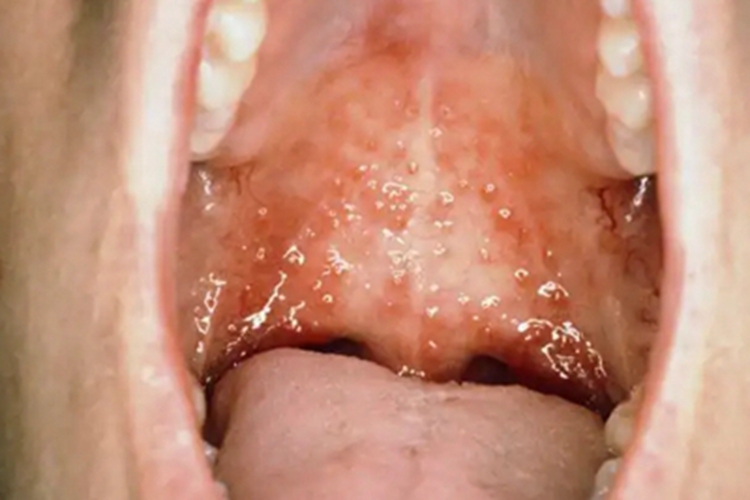 过敏性接触性口炎水疱图