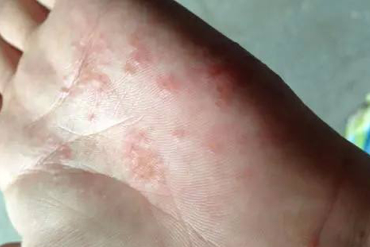 洗衣液过敏急性症状图