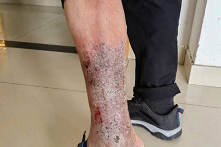 臁疮小腿有结痂和瘢痕图